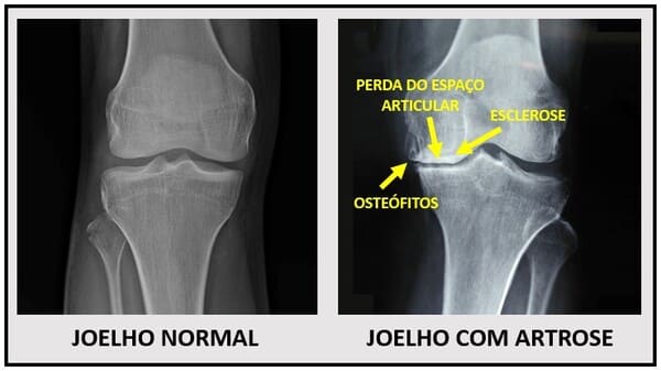Cirurgia no joelho